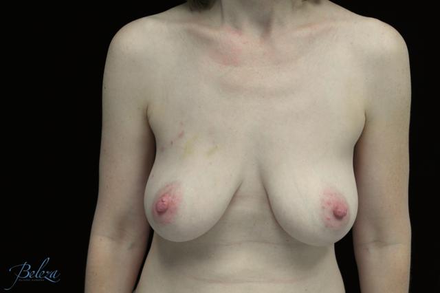Breast Augmentation before at Plastic Surgery, Pittsburgh PA: Dr. Anna Wooten, Beleza Plastic Surgery & Med Spa in Sewickley, PA