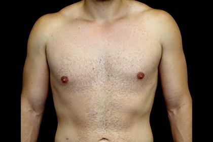 Gynecomastia Surgery after at Plastic Surgery, Pittsburgh PA: Dr. Anna Wooten, Beleza Plastic Surgery & Med Spa in Pittsburgh, PA