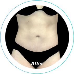Tummy Tuck after at Plastic Surgery, Pittsburgh PA: Dr. Anna Wooten, Beleza Plastic Surgery & Med Spa in Pittsburgh, PA