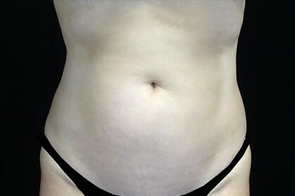 CoolSculpting after at Plastic Surgery, Pittsburgh PA: Dr. Anna Wooten, Beleza Plastic Surgery & Med Spa in Pittsburgh, PA
