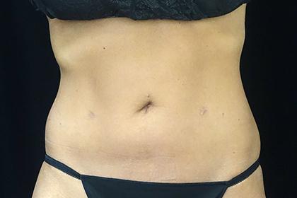 CoolSculpting after at Plastic Surgery, Pittsburgh PA: Dr. Anna Wooten, Beleza Plastic Surgery & Med Spa in Pittsburgh, PA