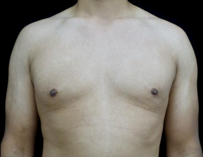 Plastic Surgery, Pittsburgh PA: Dr. Anna Wooten, Beleza Plastic Surgery & Med Spa gynecomastia after — Pittsburgh, PA