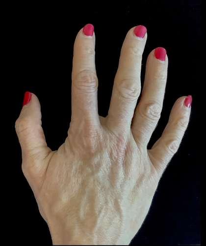 Fat Transfer after at Plastic Surgery, Pittsburgh PA: Dr. Anna Wooten, Beleza Plastic Surgery & Med Spa in Sewickley, PA