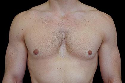 Plastic Surgery, Pittsburgh PA: Dr. Anna Wooten, Beleza Plastic Surgery & Med Spa gynecomastia after — Pittsburgh, PA