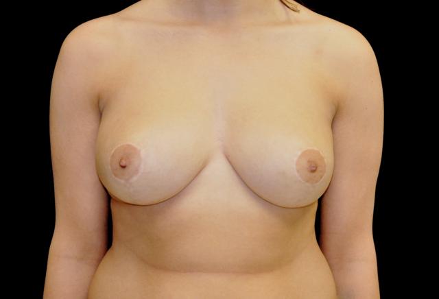 Breast Reduction after at Plastic Surgery, Pittsburgh PA: Dr. Anna Wooten, Beleza Plastic Surgery & Med Spa in Pittsburgh, PA