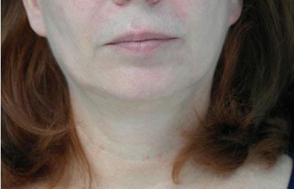 Laser Skin Resurfacing before at Plastic Surgery, Pittsburgh PA: Dr. Anna Wooten, Beleza Plastic Surgery & Med Spa in Pittsburgh, PA