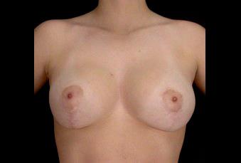Breast Lift after at Plastic Surgery, Pittsburgh PA: Dr. Anna Wooten, Beleza Plastic Surgery & Med Spa in Pittsburgh, PA