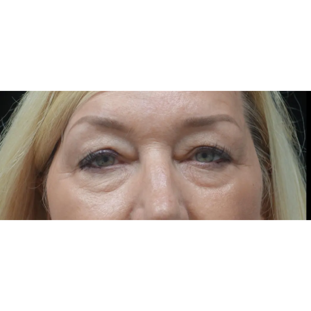 Blepharoplasty before at Plastic Surgery, Pittsburgh PA: Dr. Anna Wooten, Beleza Plastic Surgery & Med Spa in Pittsburgh, PA