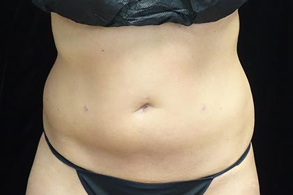 CoolSculpting before at Plastic Surgery, Pittsburgh PA: Dr. Anna Wooten, Beleza Plastic Surgery & Med Spa in Pittsburgh, PA