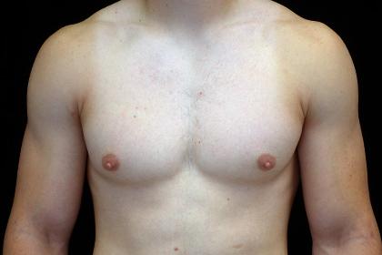 Gynecomastia Surgery before at Plastic Surgery, Pittsburgh PA: Dr. Anna Wooten, Beleza Plastic Surgery & Med Spa in Pittsburgh, PA