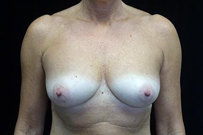 Fat Transfer after at Plastic Surgery, Pittsburgh PA: Dr. Anna Wooten, Beleza Plastic Surgery & Med Spa in Pittsburgh, PA