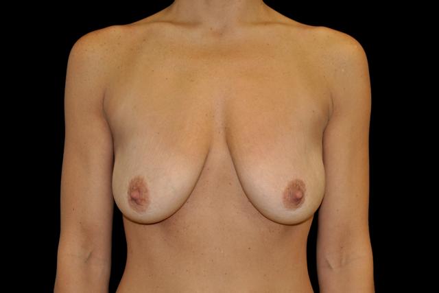 Breast Lift before at Plastic Surgery, Pittsburgh PA: Dr. Anna Wooten, Beleza Plastic Surgery & Med Spa in Pittsburgh, PA