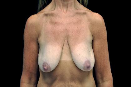 Breast Lift before at Plastic Surgery, Pittsburgh PA: Dr. Anna Wooten, Beleza Plastic Surgery & Med Spa in Pittsburgh, PA
