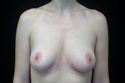Brazilian Butt Lift after at Plastic Surgery, Pittsburgh PA: Dr. Anna Wooten, Beleza Plastic Surgery & Med Spa in Pittsburgh, PA
