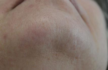 Laser Skin Resurfacing after at Plastic Surgery, Pittsburgh PA: Dr. Anna Wooten, Beleza Plastic Surgery & Med Spa in Pittsburgh, PA