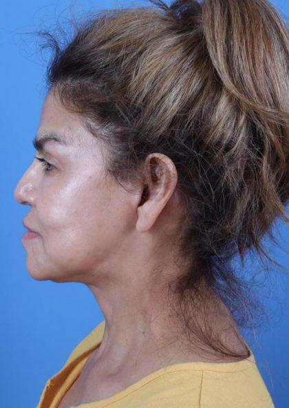 Dr. Sukkar facelift after — Houston, TX