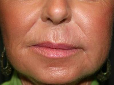 Fat Transfer after at Dr. Sukkar in Houston, TX