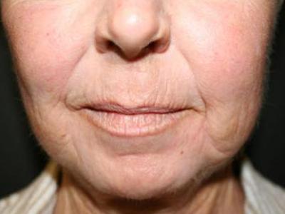 Fat Transfer before at Dr. Sukkar in Houston, TX