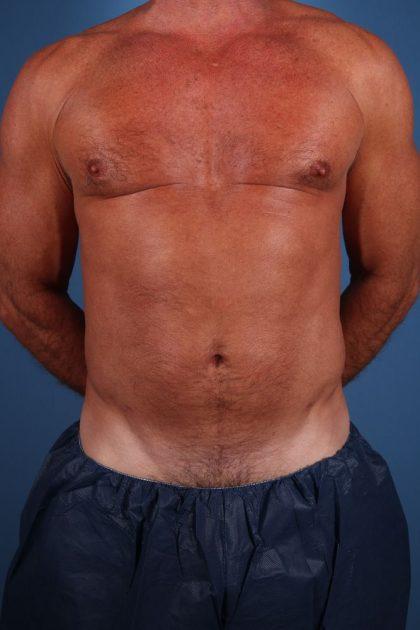 Dr. Sukkar liposuction after — Houston, TX