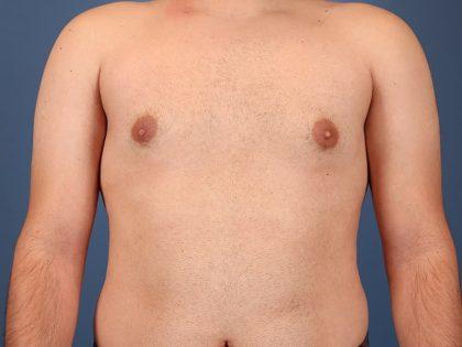 Dr. Sukkar gynecomastia after — Houston, TX