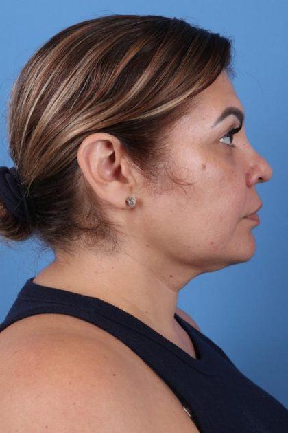 Neck Liposuction after at Dr. Sukkar in Houston, TX