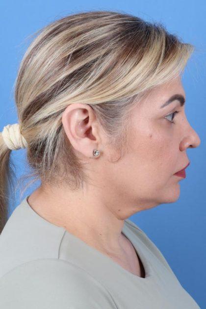Neck Liposuction before at Dr. Sukkar in Houston, TX