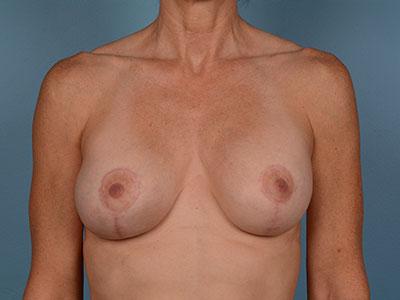 Dr. Sukkar breast augmentation after — Houston, TX