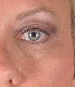 Dr. Sukkar blepharoplasty after — Houston, TX