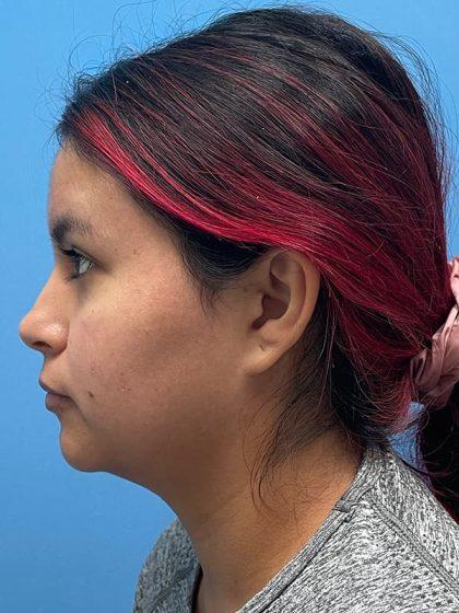 Neck Liposuction after at Dr. Sukkar in Houston, TX
