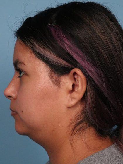 Neck Liposuction before at Dr. Sukkar in Houston, TX