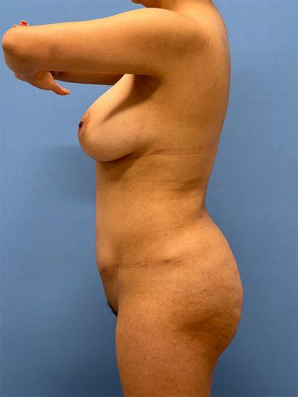 Dr. Sukkar bbl after — Houston, TX