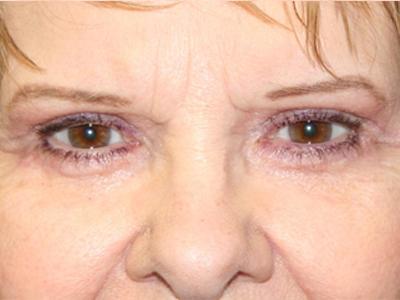 Dr. Sukkar blepharoplasty after — Houston, TX