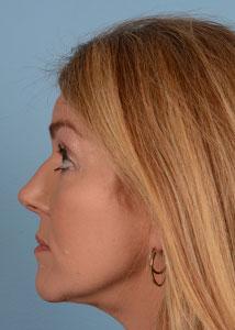 Dr. Sukkar facelift after — Houston, TX