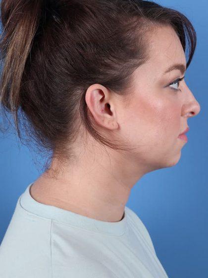 Neck Liposuction after at Dr. Sukkar in Houston, TX