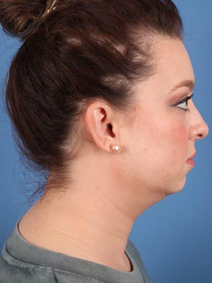 Neck Liposuction before at Dr. Sukkar in Houston, TX