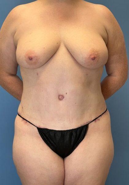 Dr. Sukkar tummy tuck after — Houston, TX