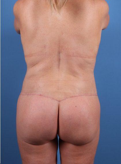 Brazilian Butt Lift after at Dr. Sukkar in Houston, TX