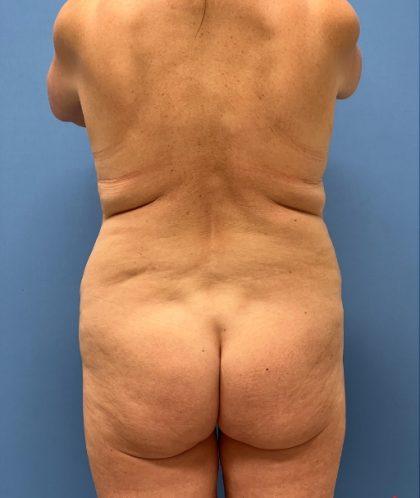 Brazilian Butt Lift before at Dr. Sukkar in Houston, TX