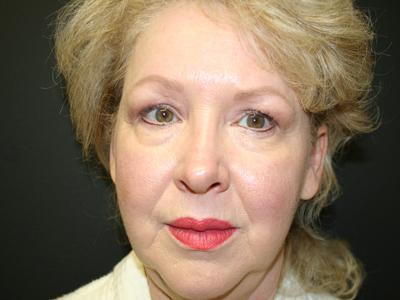 Brow Lift before at Dr. Sukkar in Houston, TX