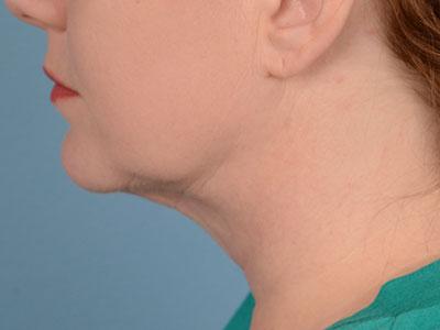 Dr. Sukkar liposuction after — Houston, TX