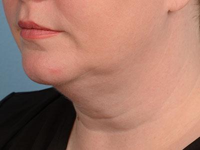 Neck Liposuction before at Dr. Sukkar in Houston, TX