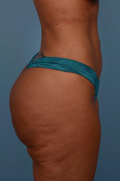 Dr. Sukkar bbl after — Houston, TX