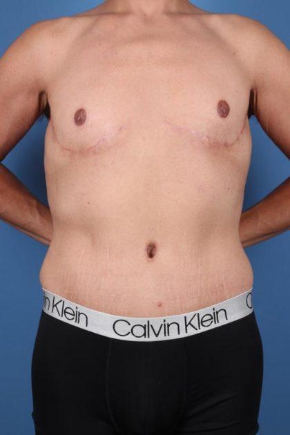 Dr. Sukkar tummy tuck after — Houston, TX