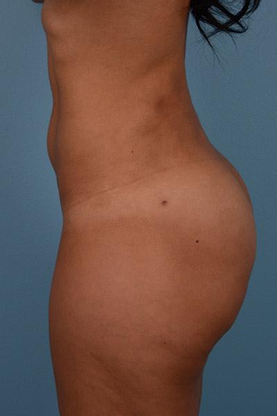 Dr. Sukkar bbl after — Houston, TX