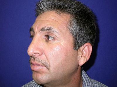 Chin Implant after at Dr. Sukkar in Houston, TX