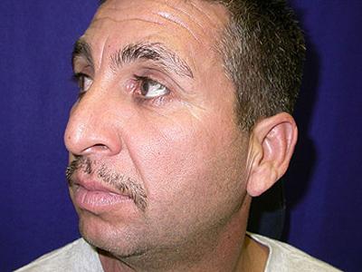 Chin Implant before at Dr. Sukkar in Houston, TX