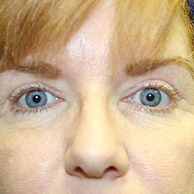 Dr. Sukkar blepharoplasty after — Houston, TX