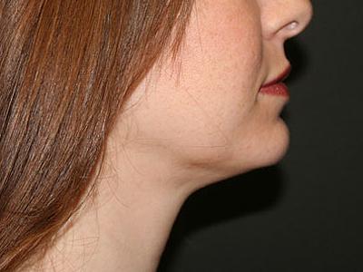 Dr. Sukkar liposuction after — Houston, TX