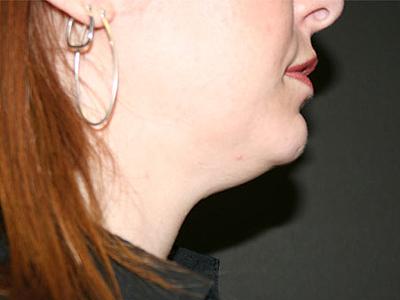 Neck Liposuction before at Dr. Sukkar in Houston, TX