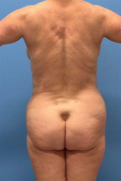 Dr. Sukkar liposuction after — Houston, TX